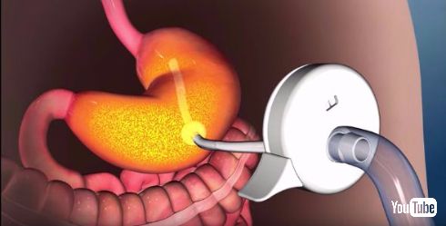 肥満向け機器「AspireAssist」