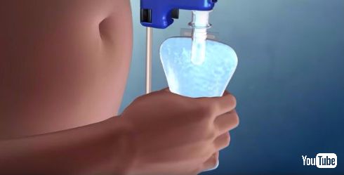 胃から排出する肥満向け機器