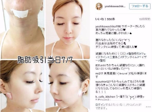 吉川ちか　脂肪吸引