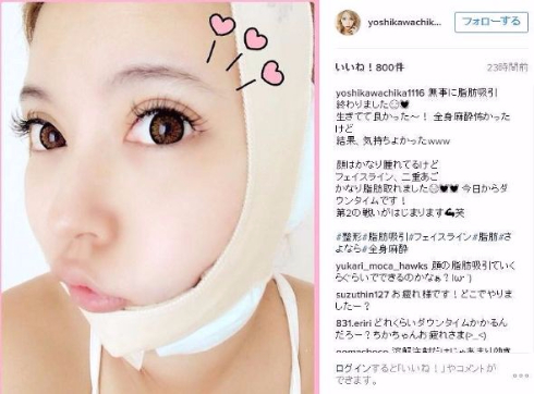 吉川ちか　整形