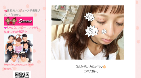 辻希美 ブログ 火傷