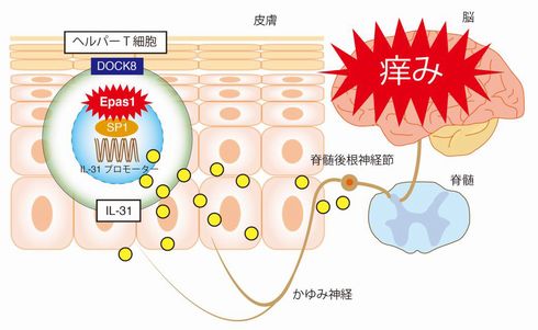 アトピー性皮膚炎　発見　メカニズム　治療薬