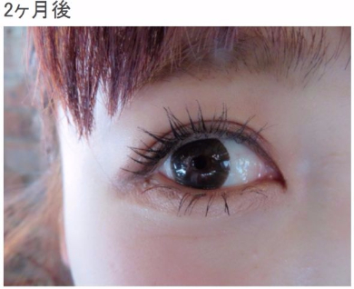 桃 あいのり 整形 二重 埋没法