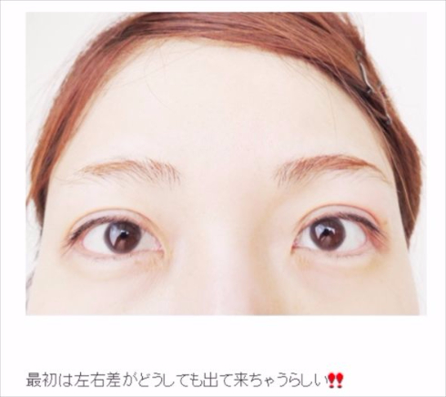 桃　プチ整形　あいのり