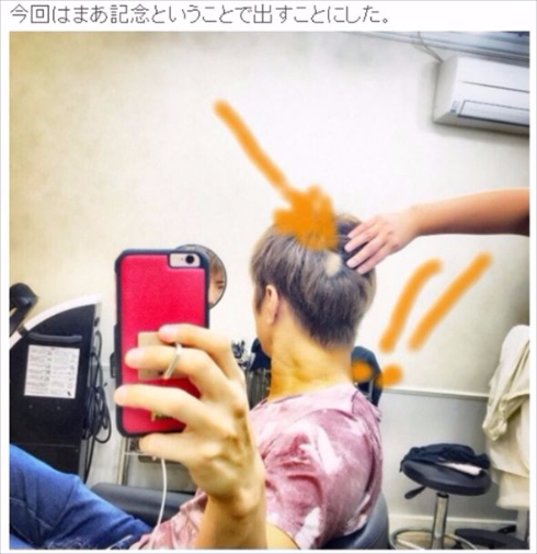 GACKT 格付けチェック 高熱 円形脱毛症