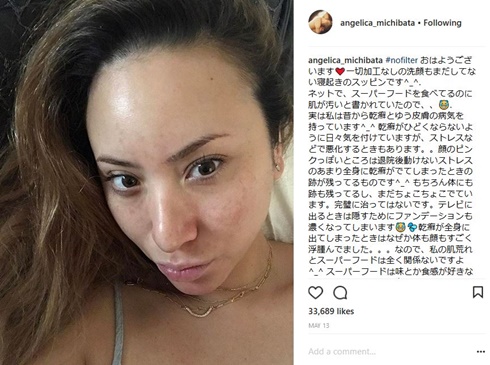 道端アンジェリカ　乾癬　すっぴん