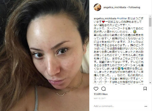 道端アンジェリカ　結婚　モデル　乾癬　皮膚疾患