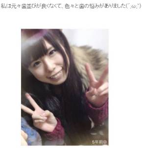 有村藍里 ブサイク ナカイの窓 矯正 口元 歯茎 手術