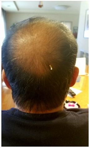 モト冬樹 ハゲ 頭 妻 ブログ 後頭部 抜け毛