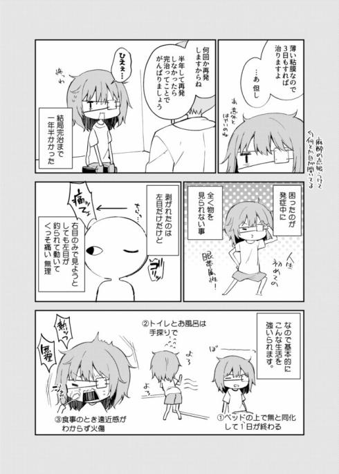 角膜剥離2
