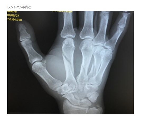 品川庄司 品川祐 骨折 ブラジリアン柔術 トレーニング レントゲン