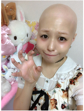 pippi 全身脱毛症 エレクトリックリボン アイドル 治療 頭髪 ウィッグ