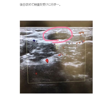 スッキリ 中山美香 しこり 病気 癌 結果 検査