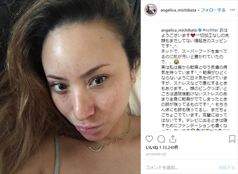 ヒャダイン 前山田健一 乾癬 道端アンジェリカ 公表 すっぴん