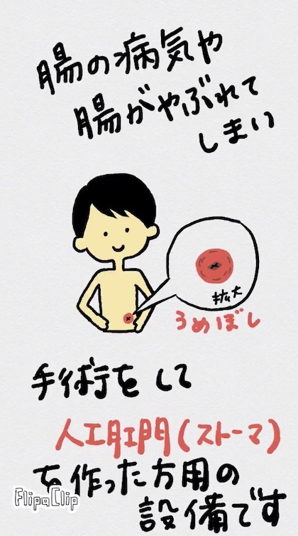 オストメイト式トイレ