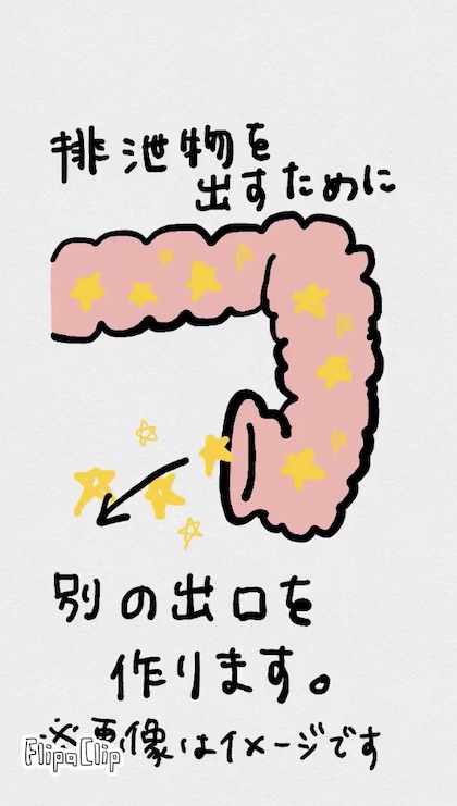 オストメイト式トイレ