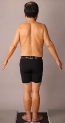 森永卓郎 RIZAP ライザップ リバウンド 糖尿病 ビフォーアフター