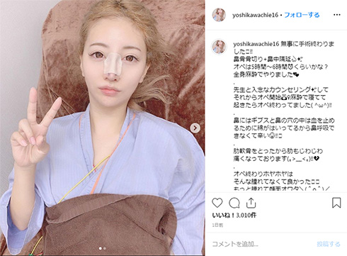 吉川ちえ 整形 鼻 鼻骨骨削り 鼻中隔延長 ダウンタイム