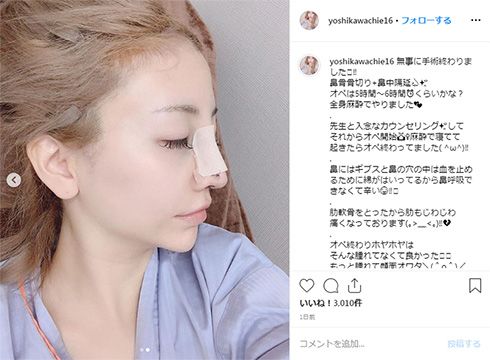 吉川ちえ 整形 鼻 鼻骨骨削り 鼻中隔延長 ダウンタイム
