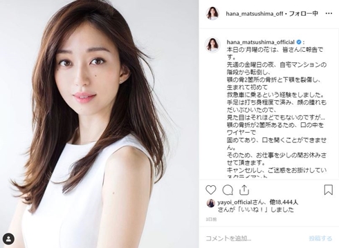 松島花 アゴ 骨折 手術 モデル