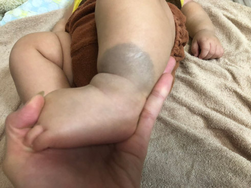 足にできた蒙古斑