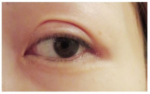 あいのり桃 整形 埋没法 再整形 二重