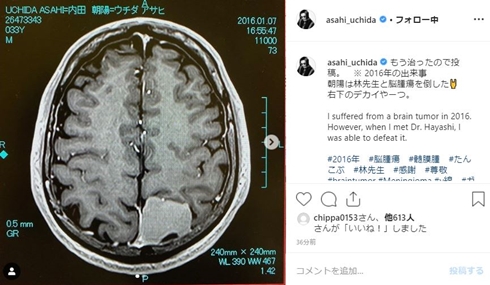 内田朝陽 病気 脳腫瘍 いつ 髄膜腫