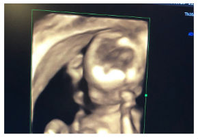 はんにゃ 川島章良 子ども 出産 お笑い コンビ