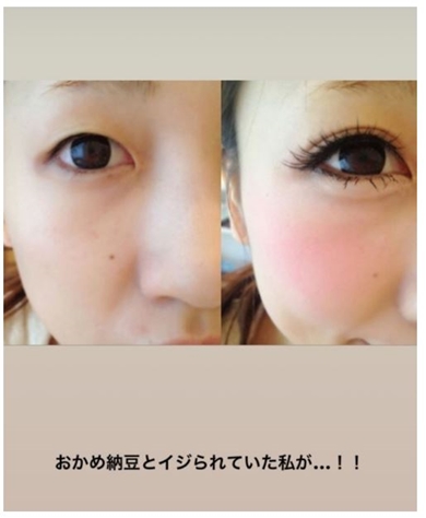 あいのり桃 整形 アイプチ ビフォー・アフター 無断使用