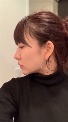 桃 あいのり 鼻 プチスレッド・ノーズアップ 鼻先 美容整形 プチ整形 二重 埋没 ブログ