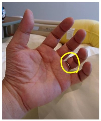 笠井信輔 笠井アナ 癌 抗がん剤 指輪