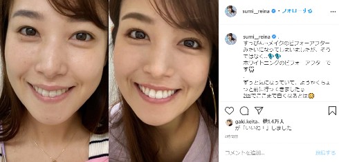 鷲見玲奈 インスタ アナウンサー 女子アナ 矯正 ホワイトニング