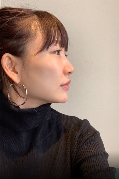 桃 あいのり 整形 鼻