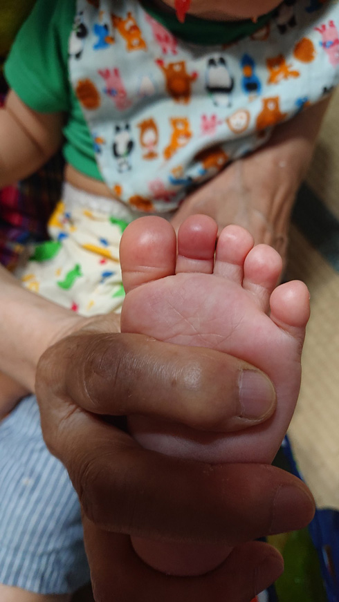 ヘアターニケットではれた赤ちゃんの指　正面から