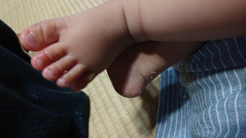 ヘアターニケットではれた赤ちゃんの指　横から