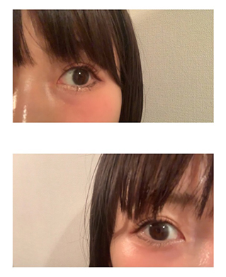 あいのり 桃 プチ整形 二重まぶた