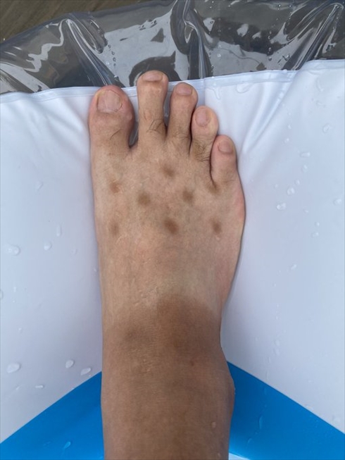 クロックス 日焼け