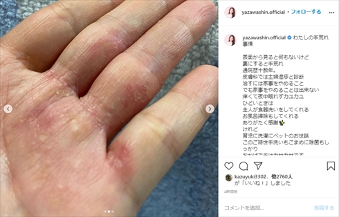 矢沢心 手荒れ 主婦 湿疹 インスタ 家事