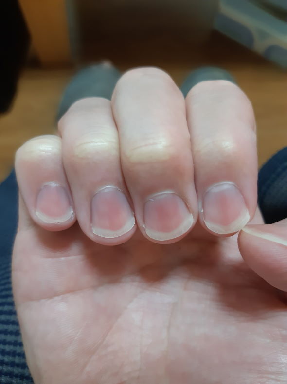 爪 ネイル ケア ビフォーアフター