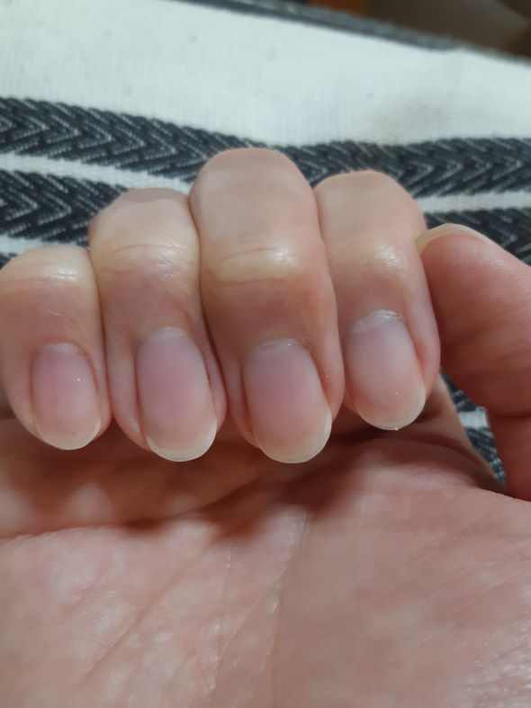 爪 ネイル ケア ビフォーアフター