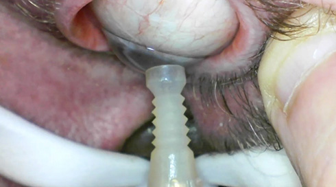 目を開けて「取り外して」と頼めばOK　コンタクトレンズの着け外しをしてくれるロボットが誕生