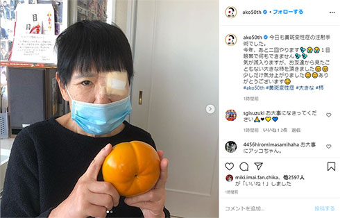 和田アキ子 黄斑変性症 眼帯