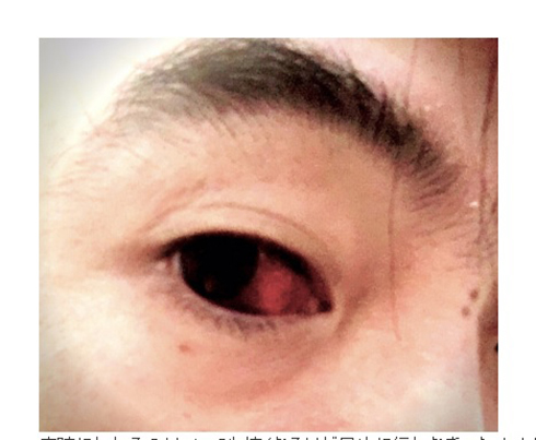 今井ゆうぞう 脳内出血