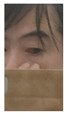 今井ゆうぞう 脳内出血