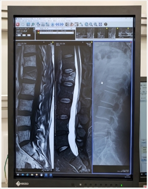 布川敏和 骨折 腰椎 圧迫骨折 肘 関節内骨折 ブログ