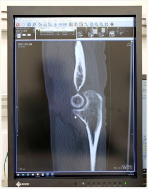 布川敏和 骨折 腰椎 圧迫骨折 肘 関節内骨折 ブログ