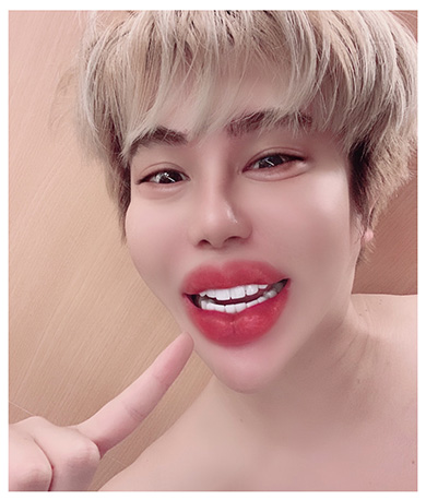 整形男子 アレン 歯抜け ジルコニア クラウン 精神 ブリッジ