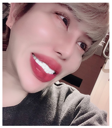 整形男子 アレン 歯抜け ジルコニア クラウン 精神 ブリッジ