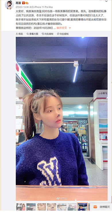 高溜 ガオ・リュー 軟骨 鼻 整形 手術 失敗 壊死 中国 女優 微博
