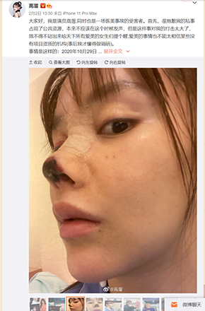 高溜 ガオ・リュー 軟骨 鼻 整形 手術 失敗 壊死 中国 女優 微博